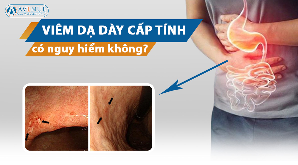 Viêm dạ dày cấp tính có nguy hiểm không